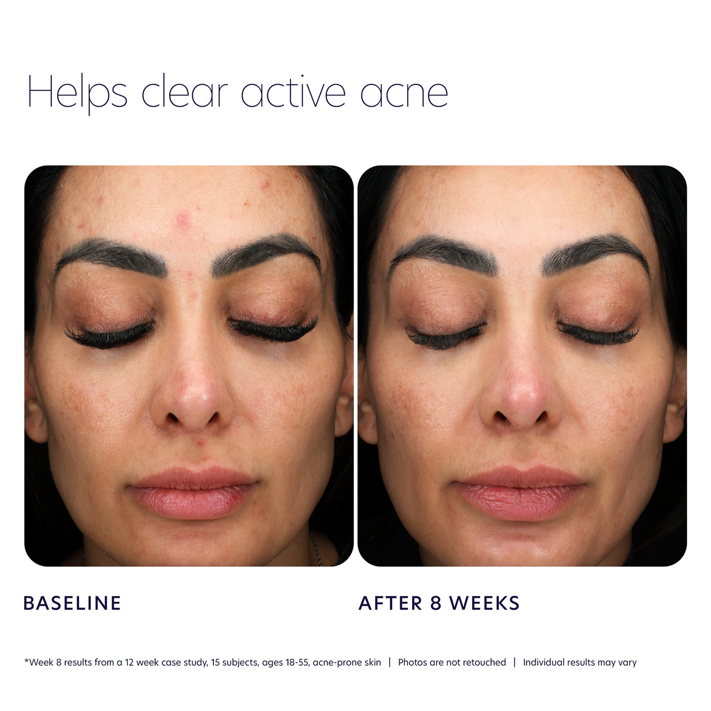 PCA SKIN Acne Control Prebiotic Gel Cleanser eight-week before and after