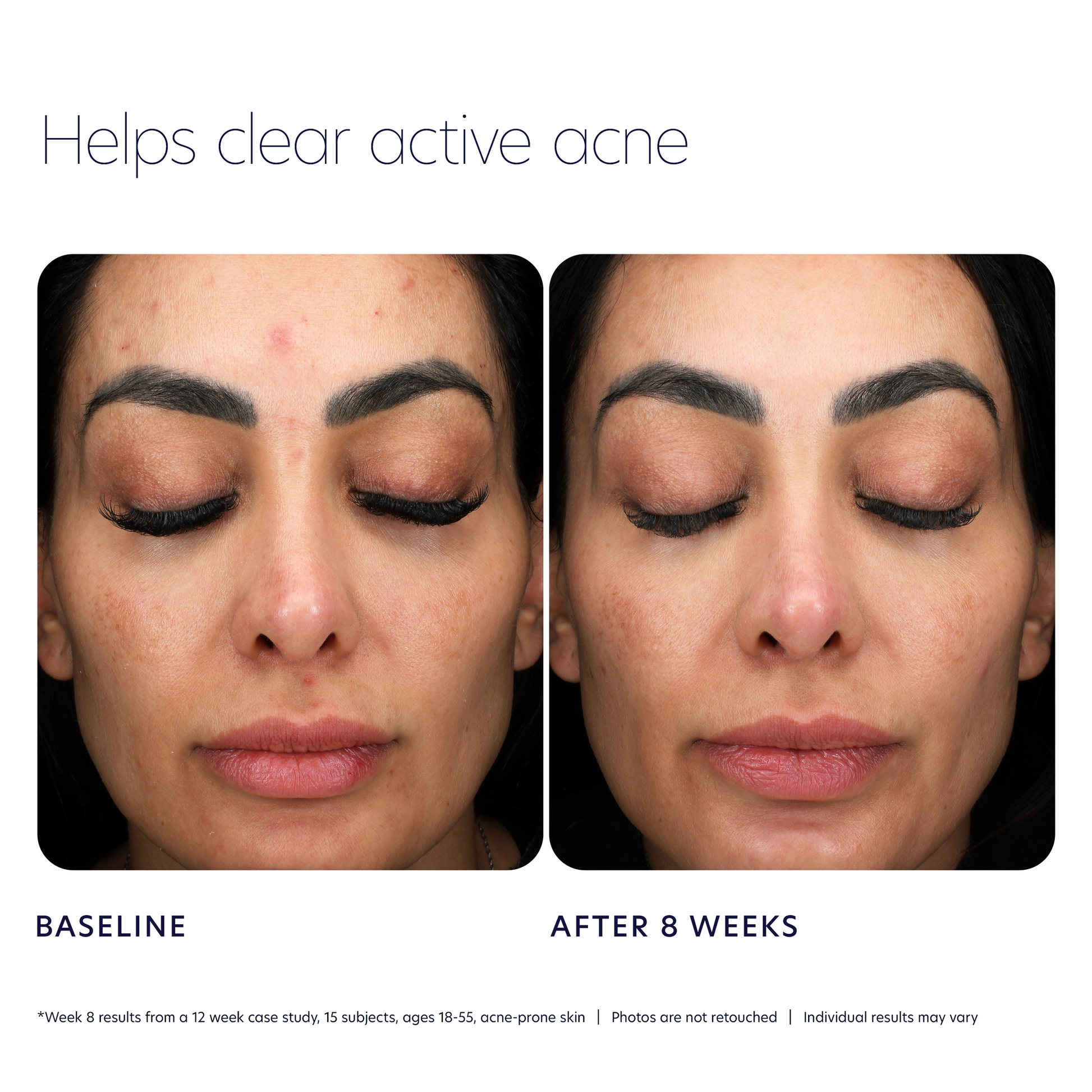 PCA SKIN Acne Control Prebiotic Gel Cleanser eight-week before and after
